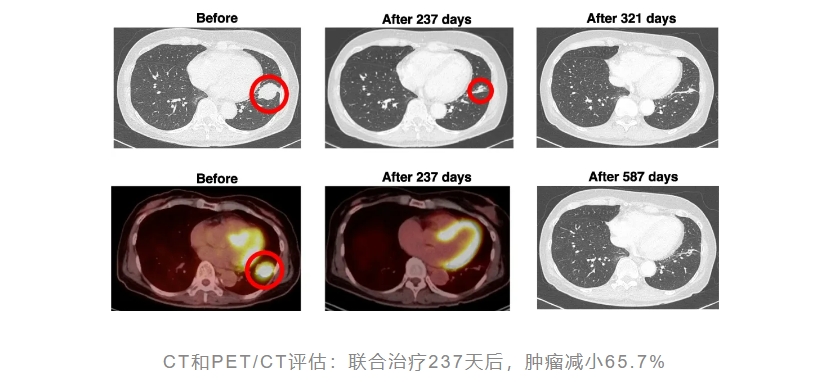 联合治疗.png